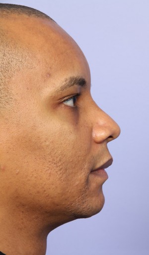 Rhinoplasty