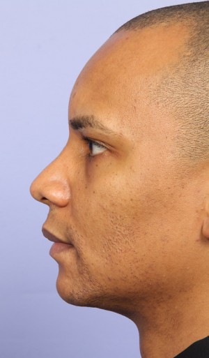 Rhinoplasty