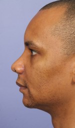 Rhinoplasty