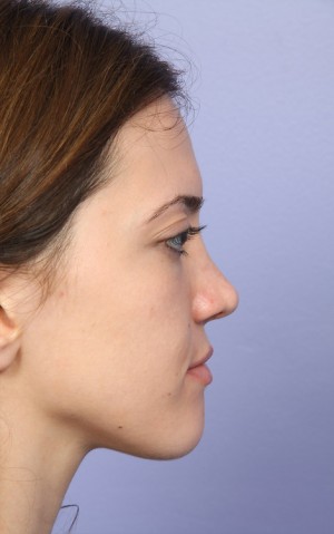 Rhinoplasty