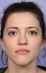 Rhinoplasty