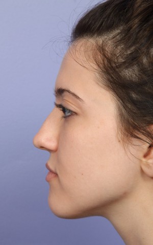 Rhinoplasty