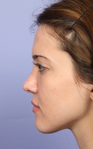 Rhinoplasty