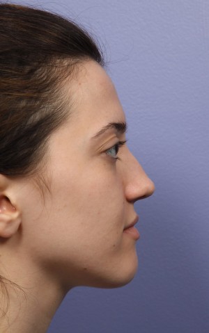 Rhinoplasty