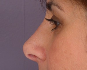 Rhinoplasty