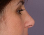 Rhinoplasty