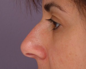 Rhinoplasty