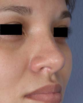 Rhinoplasty