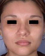 Rhinoplasty