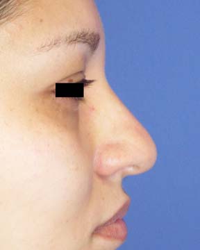 Rhinoplasty