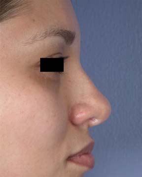 Rhinoplasty