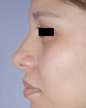 Rhinoplasty