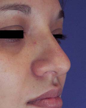 Rhinoplasty