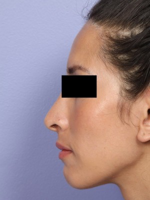 Rhinoplasty