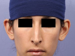 Rhinoplasty