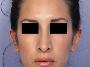 Rhinoplasty