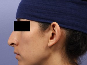 Rhinoplasty