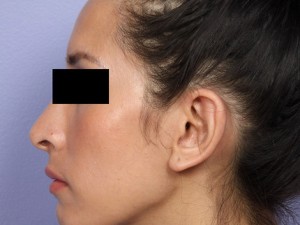 Rhinoplasty