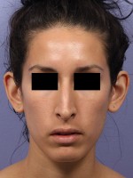 Rhinoplasty