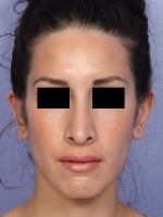 Rhinoplasty