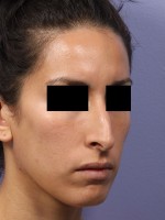 Rhinoplasty