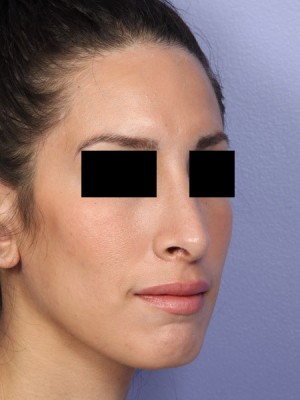 Rhinoplasty