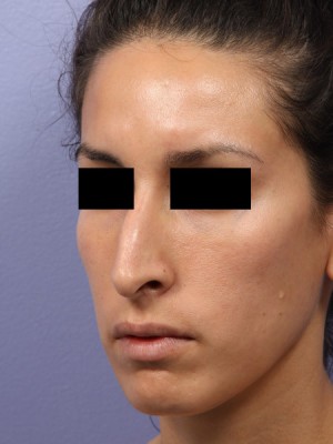 Rhinoplasty