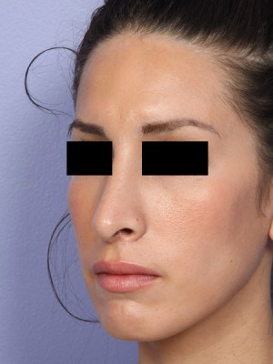 Rhinoplasty