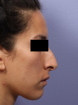 Rhinoplasty