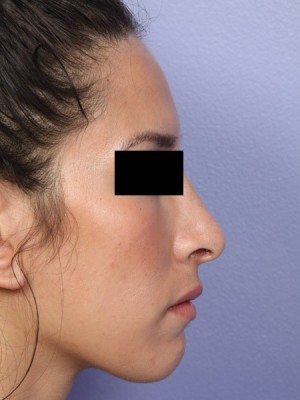 Rhinoplasty