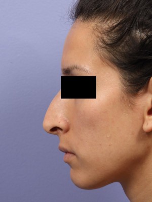 Rhinoplasty