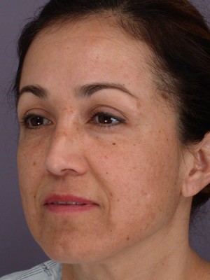 Rhinoplasty