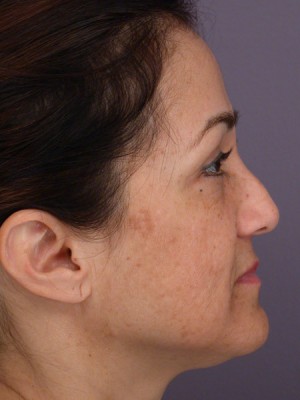 Rhinoplasty