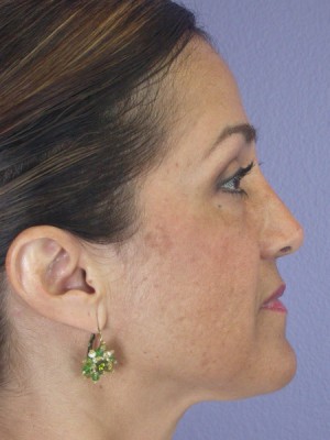 Rhinoplasty