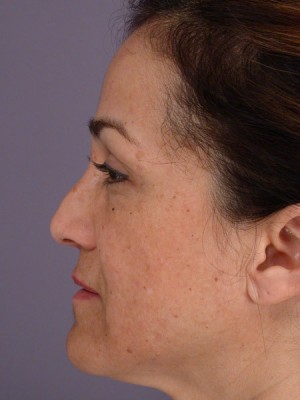 Rhinoplasty