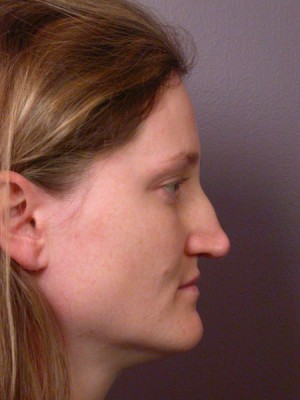 Rhinoplasty