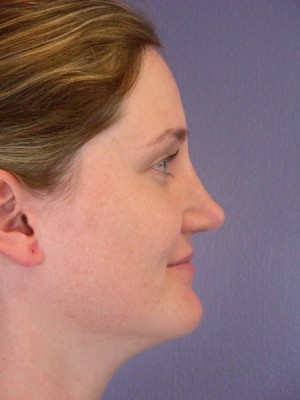 Rhinoplasty