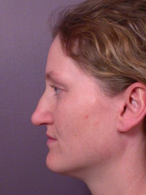 Rhinoplasty