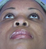 Rhinoplasty