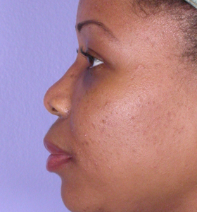 Rhinoplasty