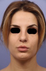 Rhinoplasty