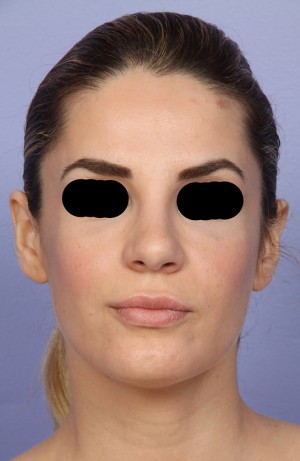 Rhinoplasty