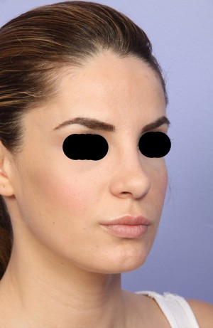 Rhinoplasty