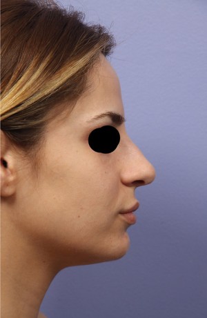 Rhinoplasty