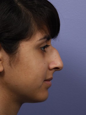 Rhinoplasty