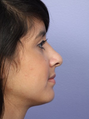 Rhinoplasty