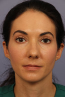 Rhinoplasty