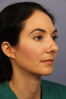 Rhinoplasty