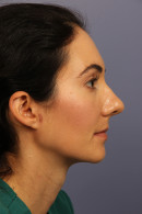 Rhinoplasty