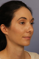 Rhinoplasty